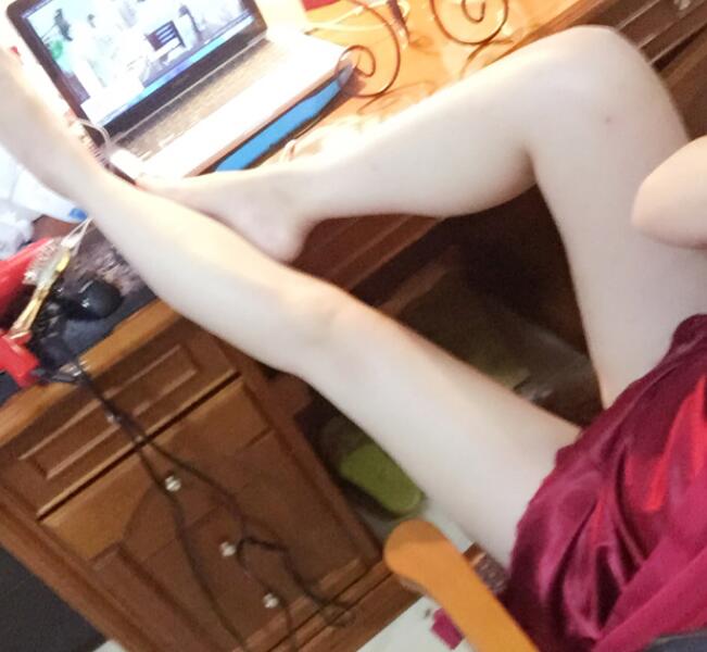 鄭州優(yōu)恩整形(原悅美)姚剛腿部吸脂三個月效果 鄭州優(yōu)恩整形(原悅美)姚剛腿部吸脂三個月效果