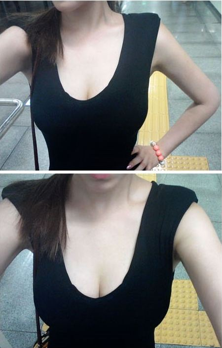 濟南鵬愛整形吳洪遠復合隆胸案例分享