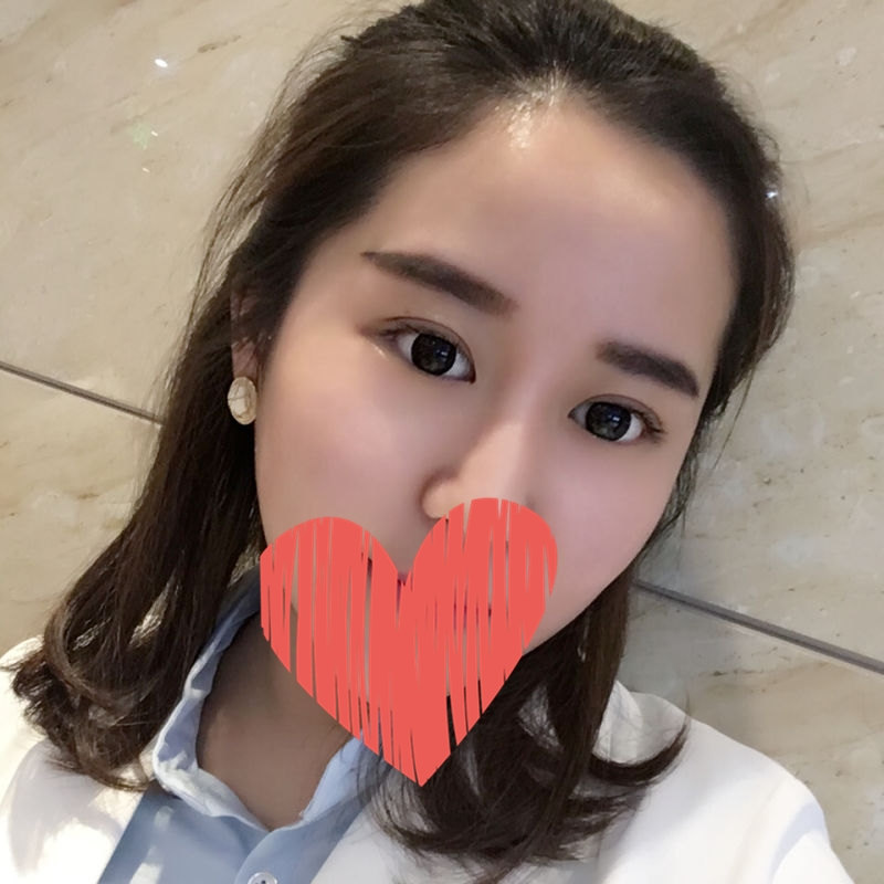 滄州中妤整形張明切開雙眼皮兩個(gè)月效果