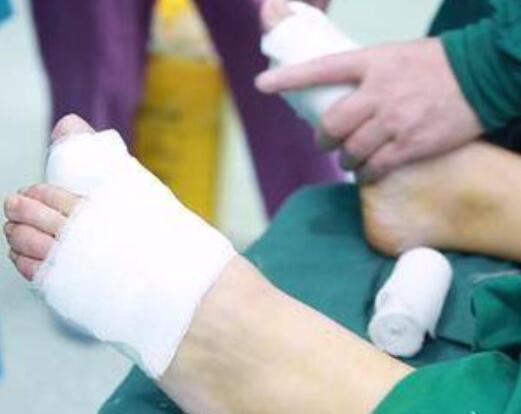 大同和平燒傷骨科醫(yī)院整形美容科大腳骨矯正術(shù)后當(dāng)天