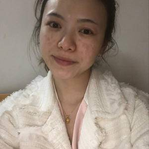 邯鄲佑熙整形孫堅(jiān)激光祛斑案例分享