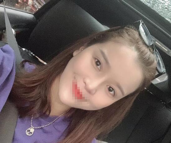 蘭州潤(rùn)妍整形鼻綜合術(shù)后四十天效果 蘭州潤(rùn)妍整形鼻綜合術(shù)后四十天效果