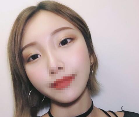 安徽省立醫(yī)院褚燕軍手術(shù)祛眼袋十天效果