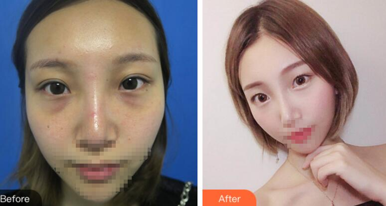 安徽省立醫(yī)院褚燕軍手術(shù)祛眼袋術(shù)后一個(gè)月效果分享