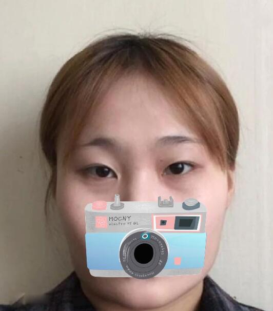 重慶華美整形下頜角整形術前效果