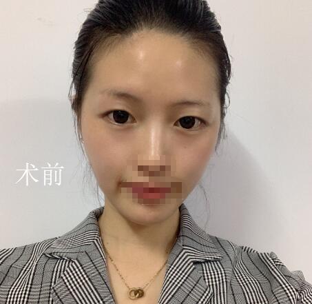 北京美萊整形杜園園雙眼皮前