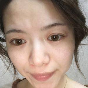 邯鄲佑熙整形孫堅(jiān)激光祛斑半個(gè)月效果