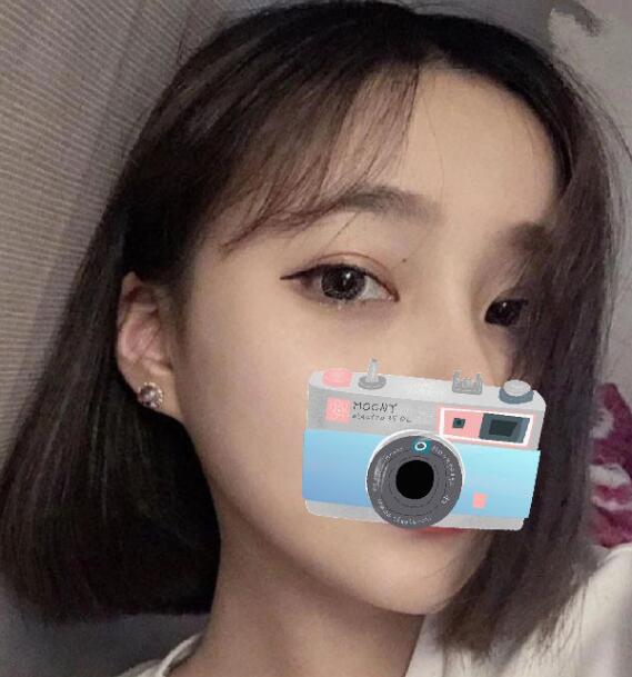 重慶華美整形下頜角整形術后一個多月效果