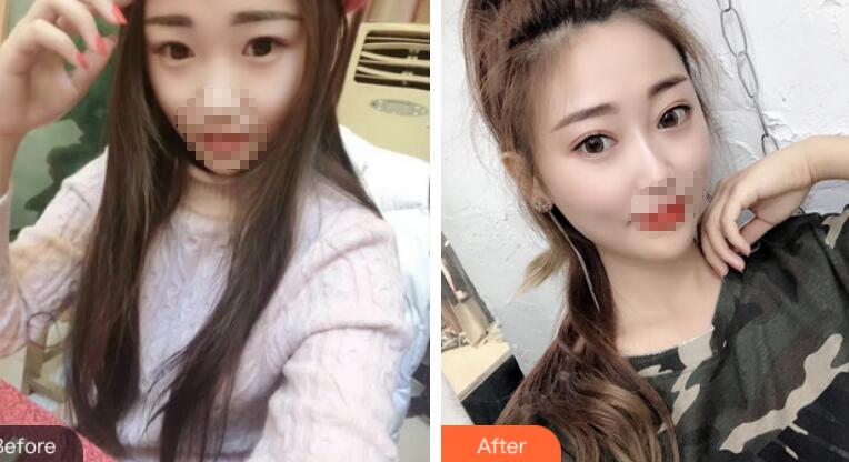 安徽省立醫(yī)院褚燕軍埋線雙眼皮術后一個月效果分享