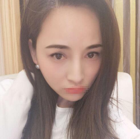 赤峰現(xiàn)代婦產(chǎn)醫(yī)院醫(yī)療美容科袁俊龍雙眼皮修復(fù)術(shù)后兩個(gè)月 赤峰現(xiàn)代婦產(chǎn)醫(yī)院醫(yī)療美容科袁俊龍雙眼皮修復(fù)術(shù)后兩個(gè)月