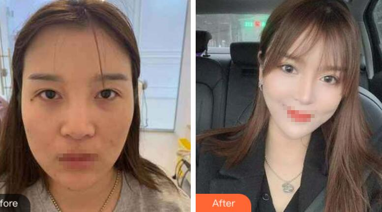 蘭州潤妍整形鼻綜合案例分享