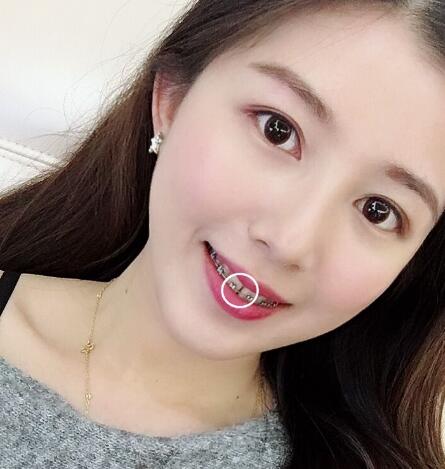 自貢華醫(yī)整形金屬托槽矯正即將結(jié)束 自貢華醫(yī)整形金屬托槽矯正即將結(jié)束