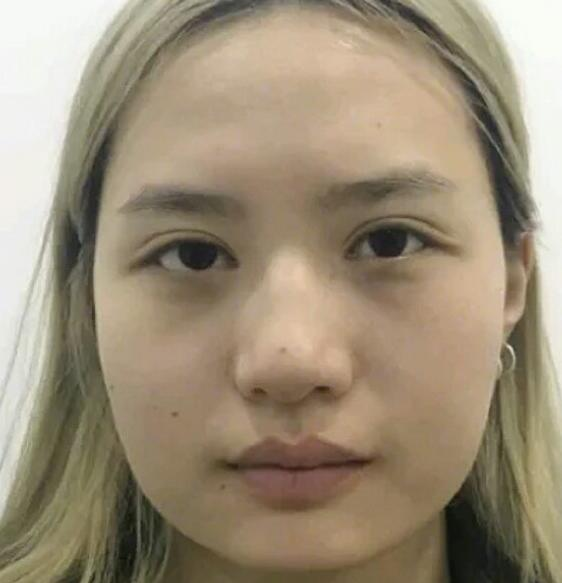 廣州中科美整形陳昌華雙下巴吸脂案例分享