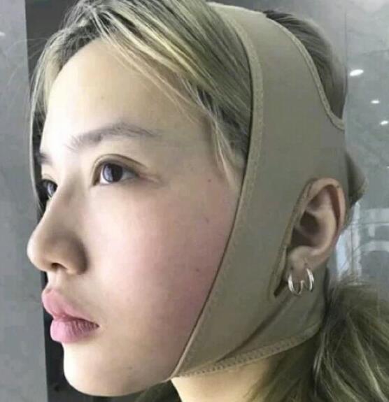 廣州中科美整形陳昌華雙下巴吸脂術(shù)后一周效果