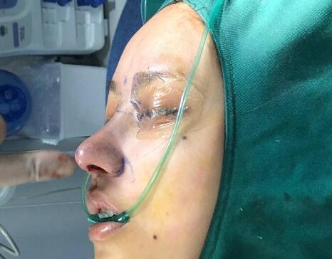 北京圣嘉榮整形呂玲玲硅膠隆鼻術(shù)后即刻