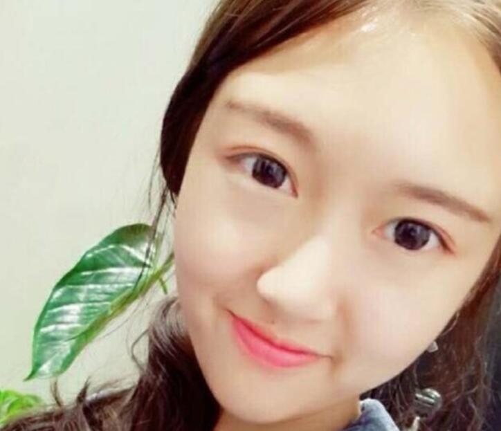 武漢伽美整形劉翼面部吸脂術(shù)后一個(gè)月效果