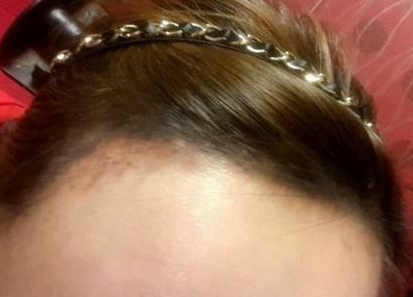 成都少城醫(yī)院自體脂肪豐額頭效果