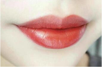 東南大學(xué)附屬中心大醫(yī)院整形外科厚唇改薄術(shù)后效果