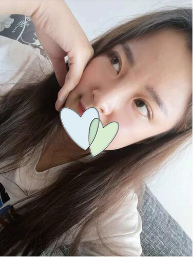 青島伊美爾劉長發(fā)做雙眼皮怎么樣？