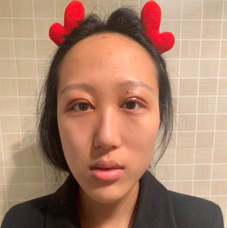 上海華美醫(yī)療美容醫(yī)院楊亞益做眼部修復(fù)整形怎么樣？