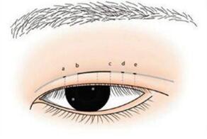 廣西帝醫(yī)醫(yī)療美容門診部雙眼皮的術(shù)后效果
