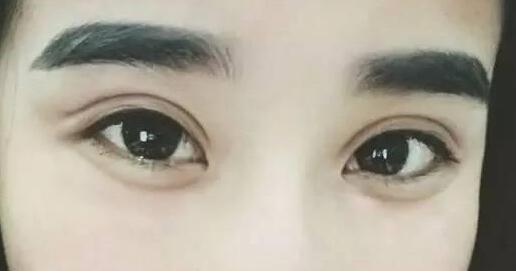 廣州愛(ài)來(lái)埋線雙眼皮手術(shù)后的效果