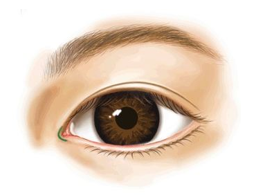 海南華美醫(yī)學美容醫(yī)院開眼角術后效果