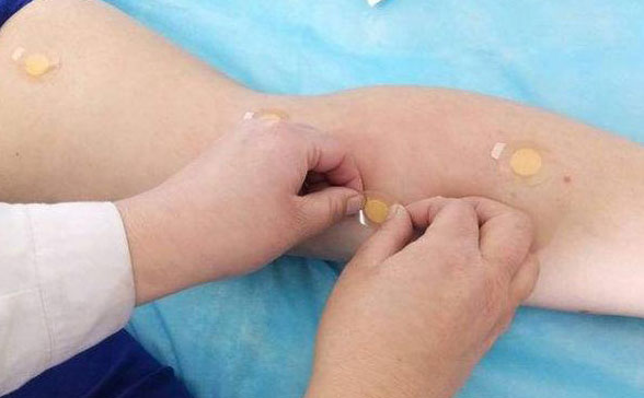 埋線減肥封穴起到什么作用?