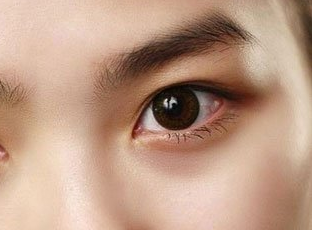 合肥龐博整形美容醫(yī)院做開(kāi)眼角術(shù)后效果