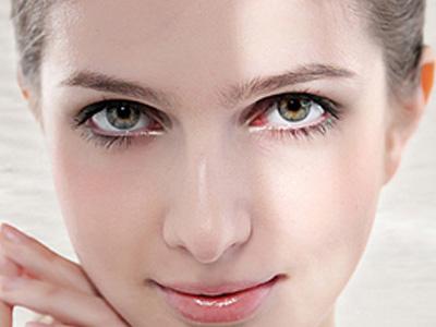 哈爾濱索菲整形美容開眼角術(shù)后效果