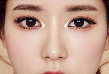 江門僑都華美整形美容醫(yī)院開內(nèi)眼角