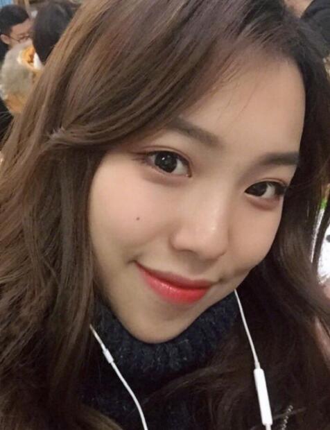 下頜角截骨完全恢復(fù)后的效果 下頜角截骨完全恢復(fù)后的效果