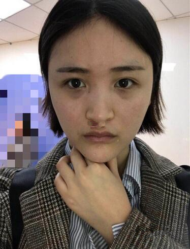 濟(jì)南鵬愛整形醫(yī)院怎么樣？濟(jì)南鵬愛王飏隆鼻案例分享