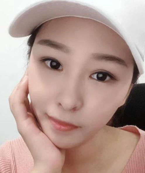 激光祛斑恢復(fù)期 激光祛斑恢復(fù)期