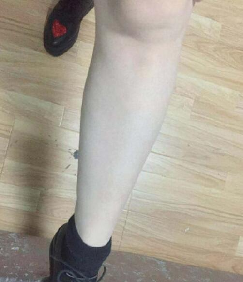 湖州尚麗醫(yī)療美容門診部宋君醫(yī)生激光脫毛案例分享