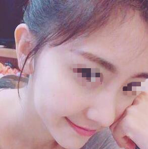 昆明麗都整形醫(yī)院李裕炯醫(yī)生耳軟骨隆鼻案例分享