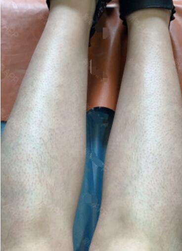 宋君醫(yī)生激光脫毛案例