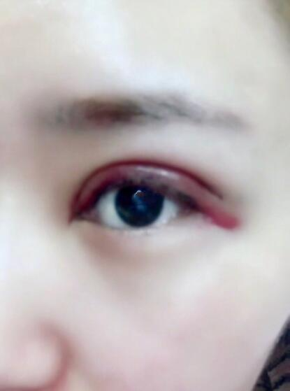 荊州華美整形醫(yī)院沈沛全切雙眼皮案例分享