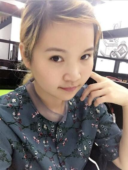 廈門華美名媛整形醫(yī)生賈虹下頜角削骨案例效果對比圖！