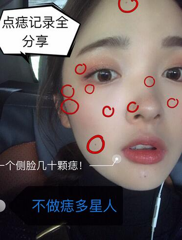 北京蕾士悅丁香醫(yī)生激光點(diǎn)痣案例效果分享