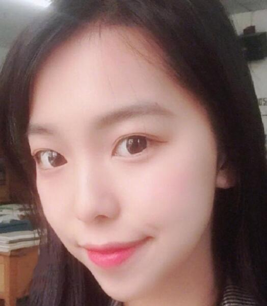 下頜角截骨手術(shù)后 下頜角截骨手術(shù)后