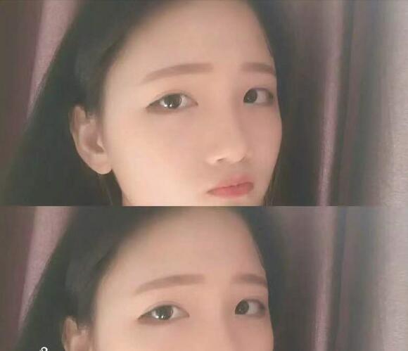 做切開雙眼皮恢復(fù)后的我