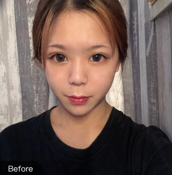 長沙梵童王志軍自體脂肪填充案例效果對比