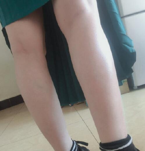 宋君醫(yī)生激光脫毛手術(shù)效果