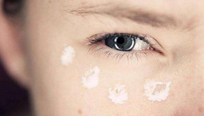 青島秋韻風(fēng)疤痕整形?？漆t(yī)院激光祛眼袋