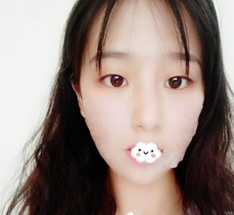 北京玲瓏梵宮整形醫(yī)生張蔚宣下頜角案例100天效果對(duì)比圖