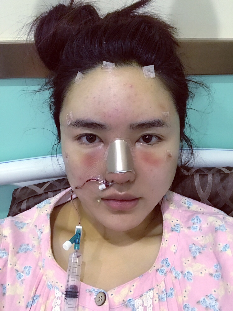 膨體隆鼻手術過程 膨體隆鼻手術過程