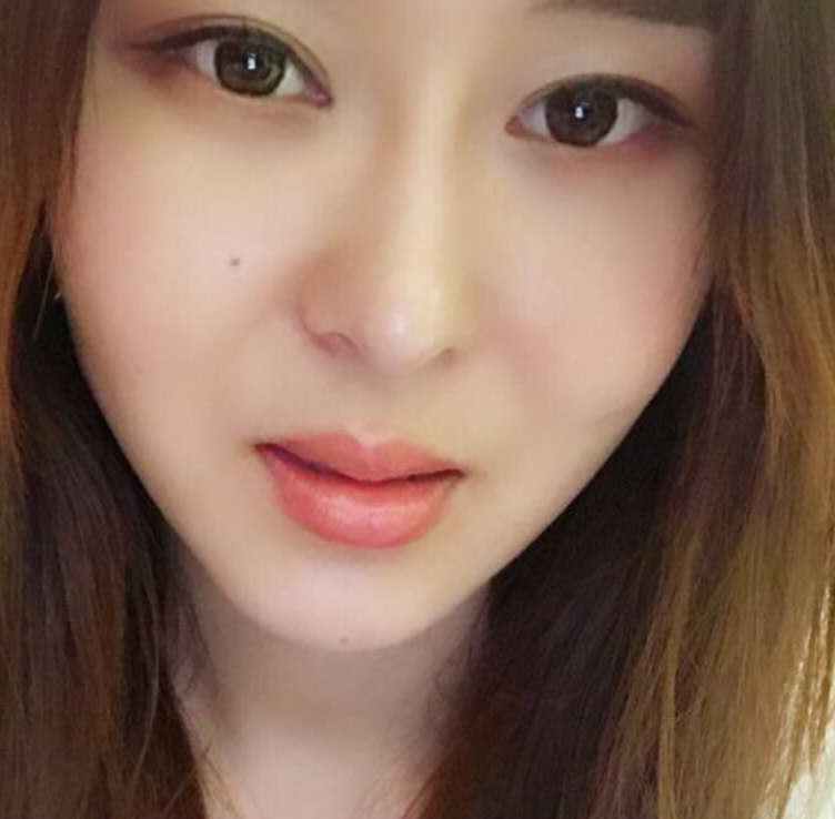 鄭州優(yōu)恩整形王波醫(yī)生玻尿酸豐唇案例效果對比圖