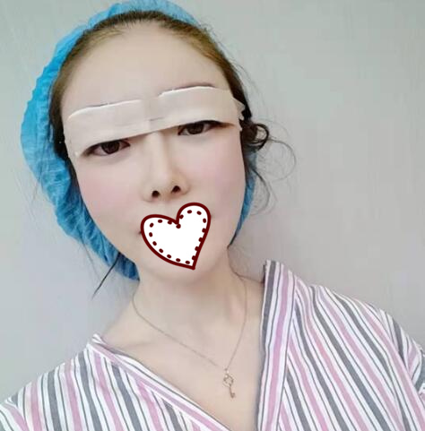 剛做完雙眼皮手術(shù)，還在恢復(fù)過程中