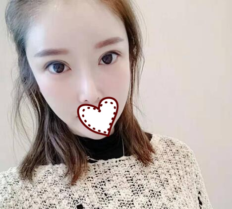 雙眼皮完全恢復(fù)之后的效果